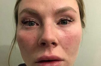 Екатеринбург ожог глаз прокуратура Свердловская область